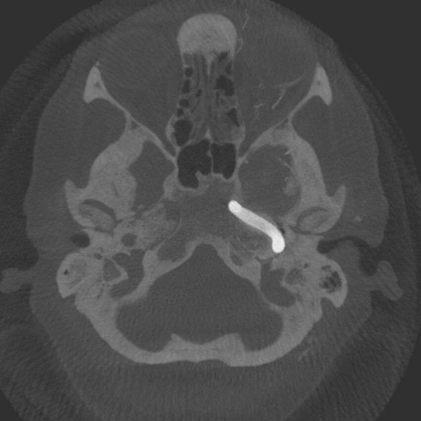 Acute subarachnoid hemorrhage and accessory anterior cerebral artery (Radiopaedia 69231-79010 C 8).jpg