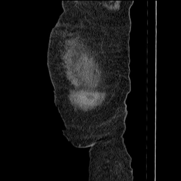 File:Acute tubular necrosis (Radiopaedia 28077-28334 H 5).jpg