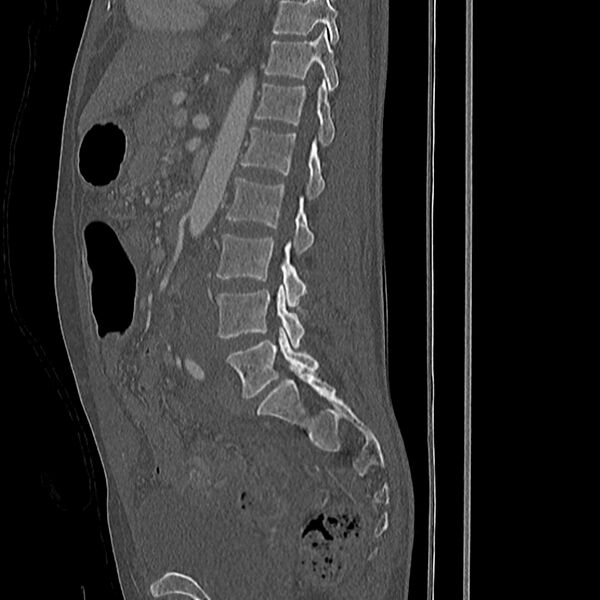 File:Acute vertebral body compression fractures (Radiopaedia 31757-32693 Sagittal bone window 20).jpg