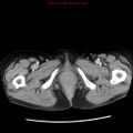 Adenocarcinoma of the colon (Radiopaedia 8191-9039 Axial liver window 81).jpg