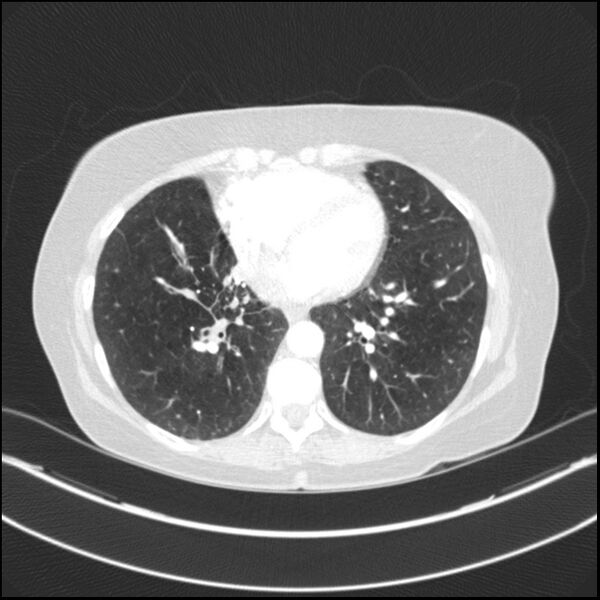 File:Adenocarcinoma of the lung (Radiopaedia 44205-47803 Axial lung window 61).jpg