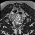 Adenoma malignum of the cervix (Radiopaedia 24460-24765 Coronal T2 23).jpg