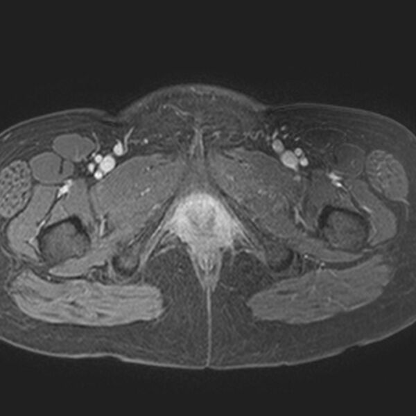 File:Adenomyoma of the uterus (Radiopaedia 9871-10439 Axial T1 C+ fat sat 2).jpg