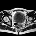 Adenomyoma of the uterus (huge) (Radiopaedia 9870-10438 Axial T2 13).jpg