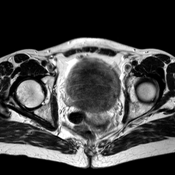 File:Adenomyoma of the uterus (huge) (Radiopaedia 9870-10438 Axial T2 13).jpg