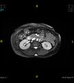 Adenomyosis (Radiopaedia 43504-46889 Axial 2D FIESTA 21).jpg