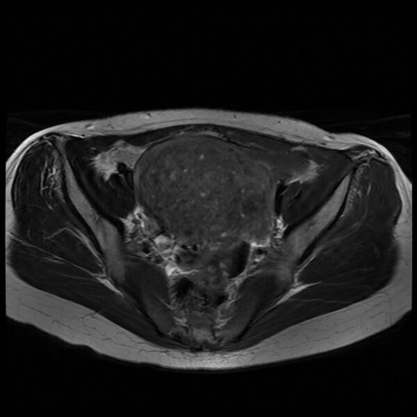 File:Adenomyosis on MRI (Radiopaedia 29328-29780 Axial T2 4).jpg