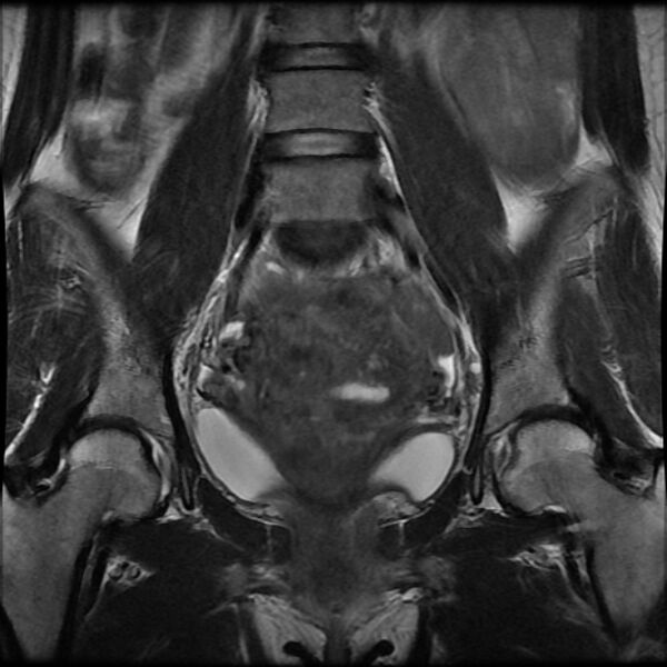 File:Adenomyosis on MRI (Radiopaedia 29328-29780 Coronal T2 8).jpg