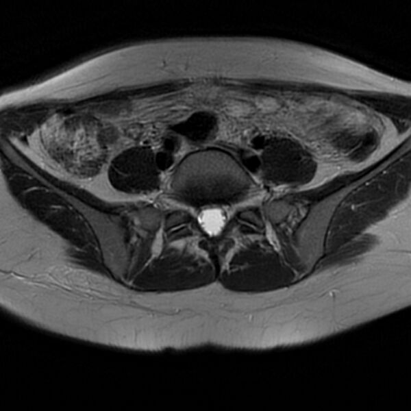 File:Adenomyosis within a septate uterus (Radiopaedia 69963-79981 Axial T2 8).jpg
