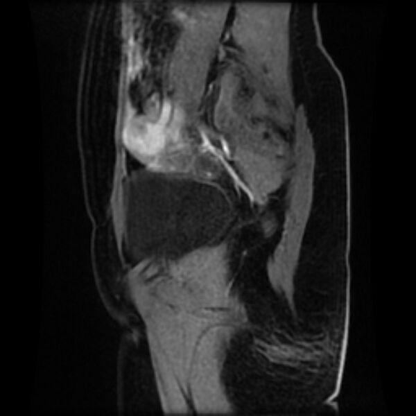 File:Adenomyosis within a septate uterus (Radiopaedia 69963-79981 Sagittal LAVA-Dyn 6).jpg