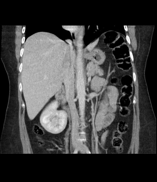 File:Adrenal cortical carcinoma with IVC invasion and thrombosis (Radiopaedia 34307-35597 Coronal C+ portal venous phase 28).jpg