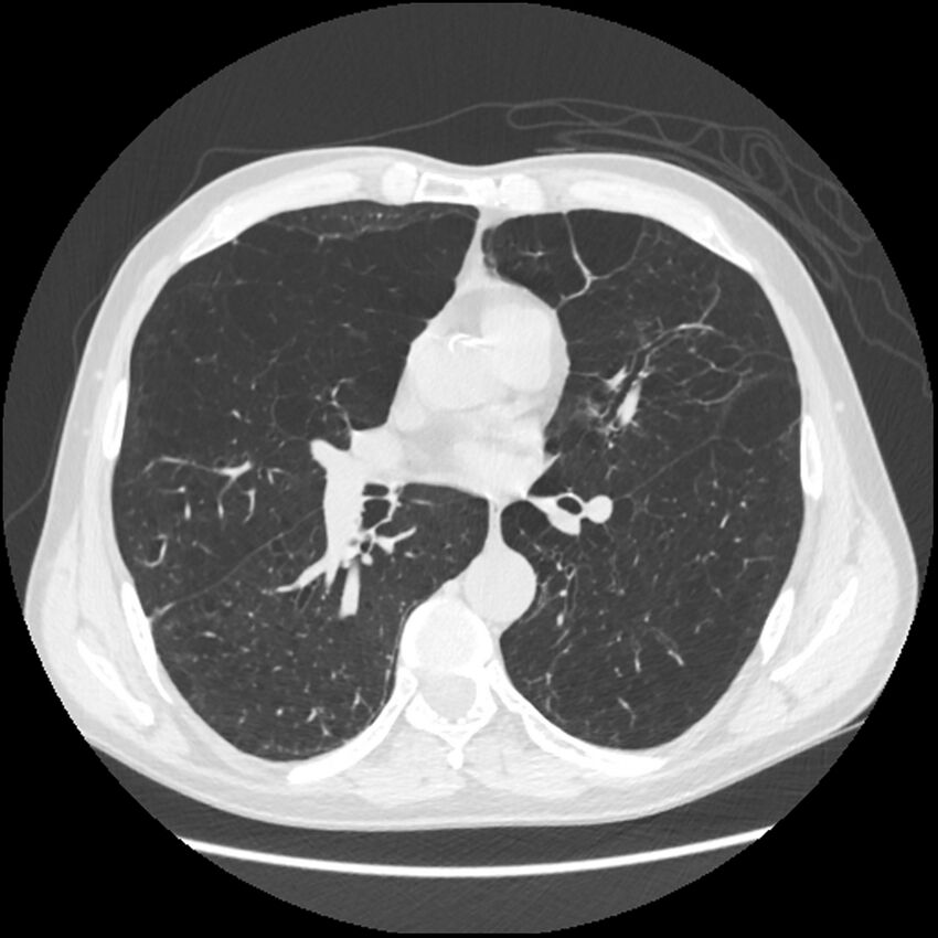 Alpha-1-antitrypsin deficiency (Radiopaedia 40993-43722 Axial lung window 125).jpg