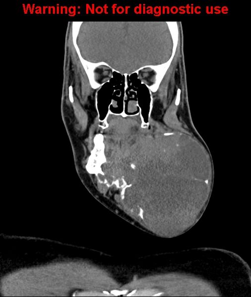 File:Ameloblastoma (Radiopaedia 33126-34164 D 27).jpg