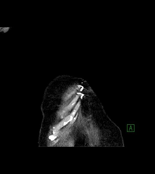File:Amiodarone deposition in the liver (Radiopaedia 77587-89780 Coronal non-contrast 9).jpg