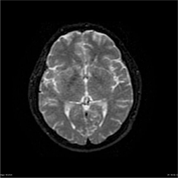 File:Amnestic syndrome secondary to hypoxic brain injury (Radiopaedia 24743-25004 DWI 48).jpg