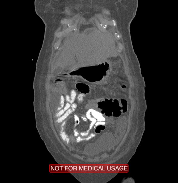 File:Amoebic enterocolitis with liver abscess (Radiopaedia 35100-36609 B 14).jpg