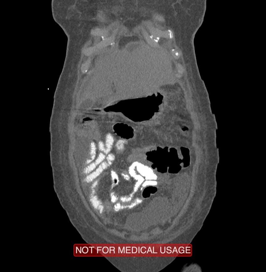Amoebic enterocolitis with liver abscess (Radiopaedia 35100-36609 B 14).jpg