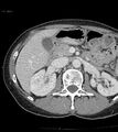 Ampulla of Vater metastasis (Radiopaedia 27820-28065 A 4).jpg