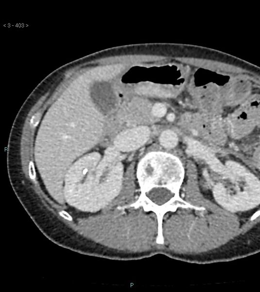 File:Ampulla of Vater metastasis (Radiopaedia 27820-28065 A 7).jpg