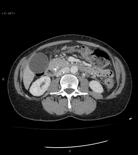 File:Ampulla of Vater metastasis (Radiopaedia 27820-28069 A 85).jpg