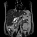 Ampullary tumor (Radiopaedia 27294-27479 Coronal T2 12).jpg