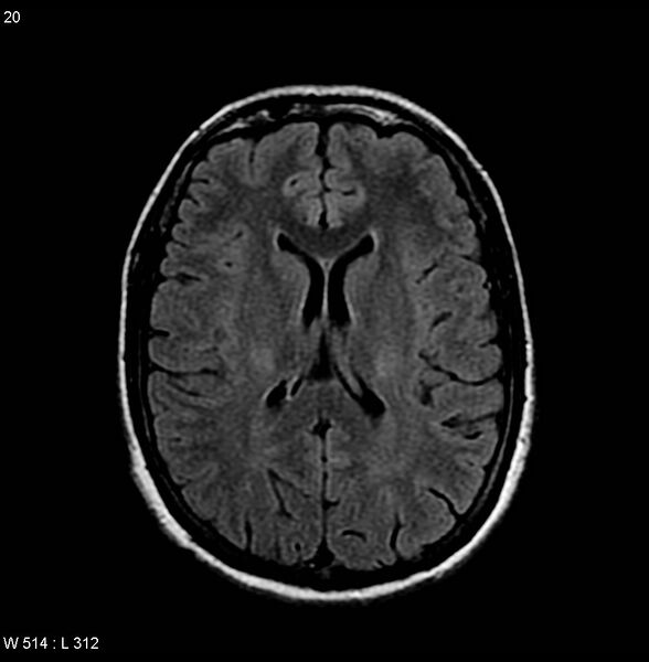 File:Amyotrophic lateral sclerosis (Radiopaedia 4719-6744 Axial FLAIR 5).jpg