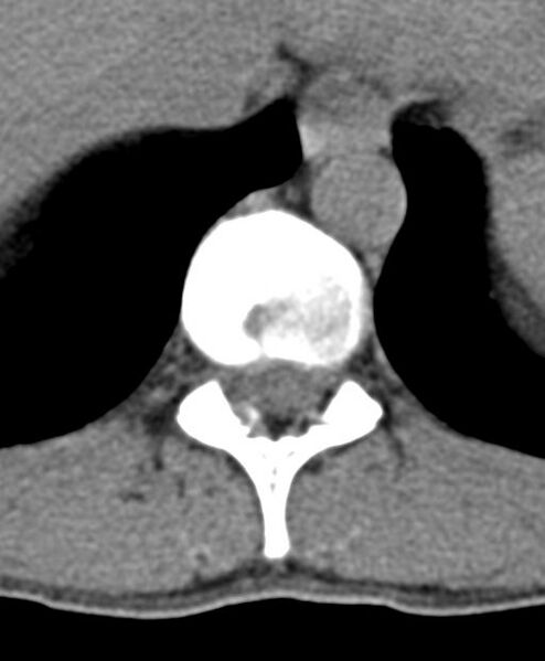File:Aneurysmal bone cyst T11 (Radiopaedia 29294-29721 Axial non-contrast 37).jpg