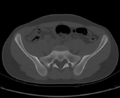 Aneurysmal bone cyst of ischium (Radiopaedia 25957-26094 Axial bone window 21).png