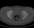 Aneurysmal bone cyst of ischium (Radiopaedia 25957-26094 Axial bone window 55).png