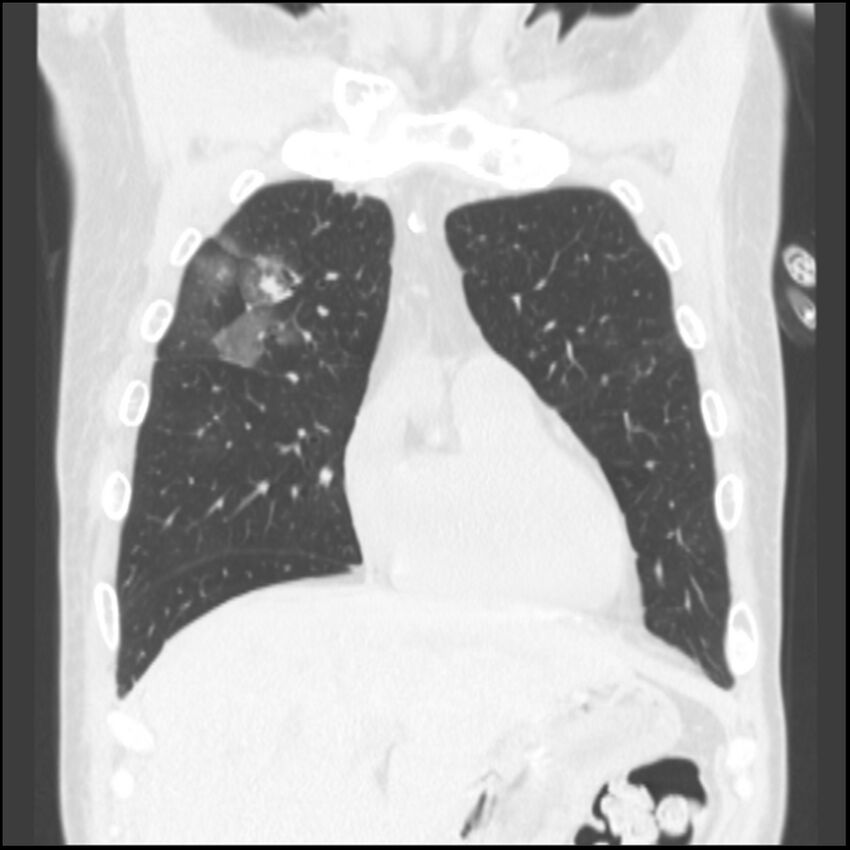 Angioinvasive aspergillosis (Radiopaedia 43957-47466 Coronal lung window 69).jpg