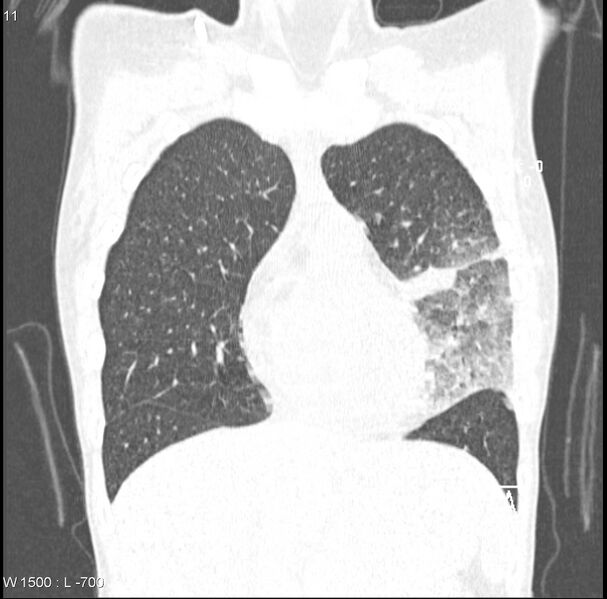 File:Angioinvasive aspergillosis (Radiopaedia 8651-9466 Coronal lung window 1).jpg