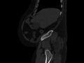 Ankylosing spondylitis (Radiopaedia 44609-48357 Sagittal bone window 11).jpg