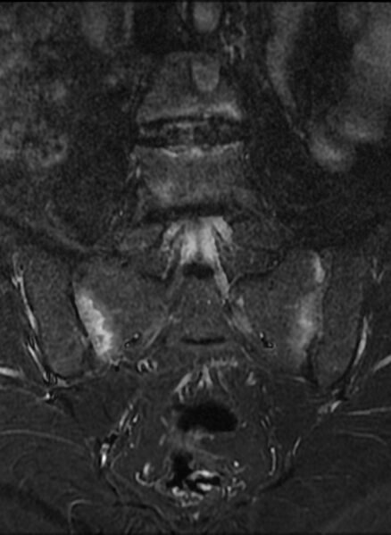 File:Ankylosing spondylitis - Andersson lesion (Radiopaedia 81878-95838 Coronal STIR 7).jpg