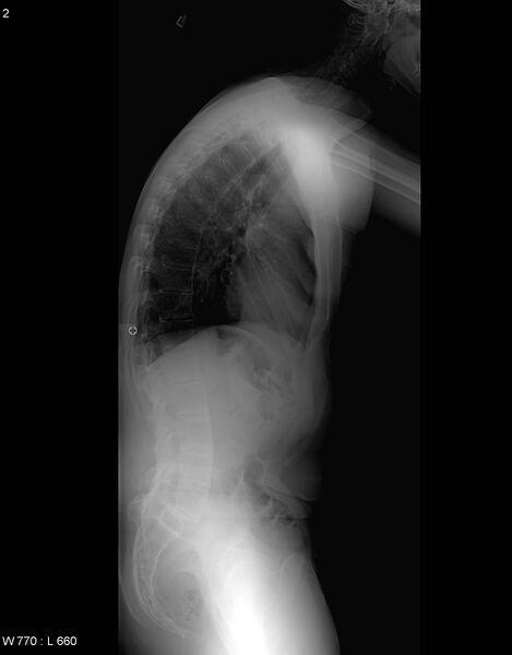 File:Ankylosing spondylitis - full spine (Radiopaedia 5614-7334 Lateral 1).jpg