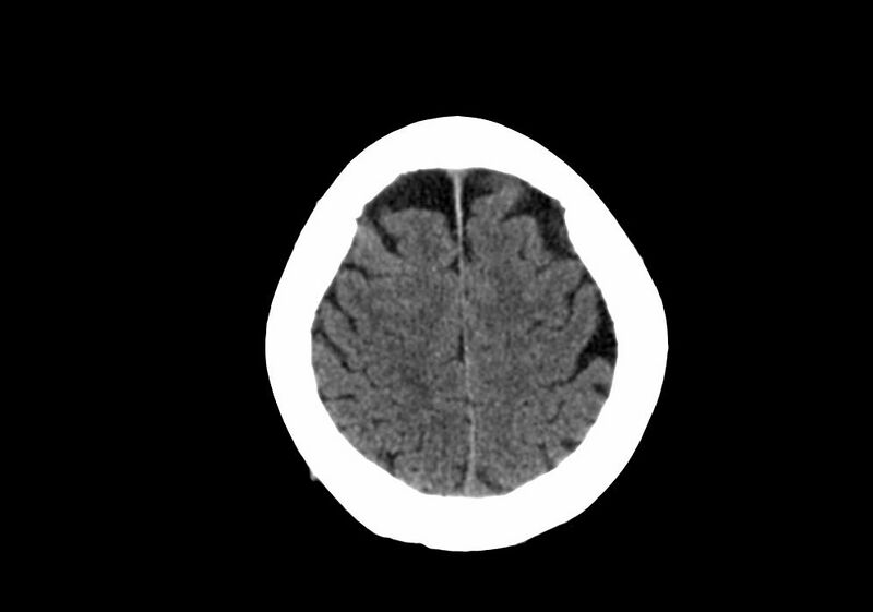 File:Anomalous intracranial venous drainage (Radiopaedia 28161-28418 Axial non-contrast 37).jpg