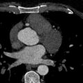 Anomalous origin of the left coronary artery with malignant course (Radiopaedia 77842-90126 C 72).jpeg