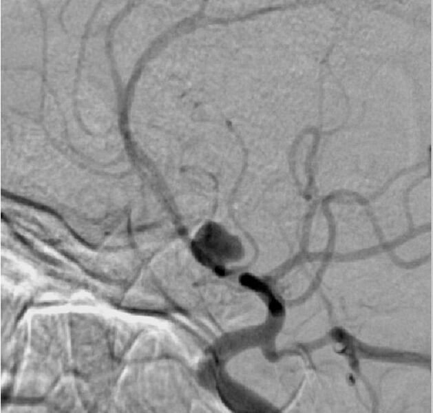 File:Anterior communicating artery aneurysm (Radiopaedia 30938-31638 A 1).JPG