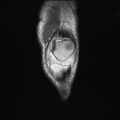 Anterior cruciate ligament full thickness tear (Radiopaedia 66268-75467 Coronal T1 3).jpg