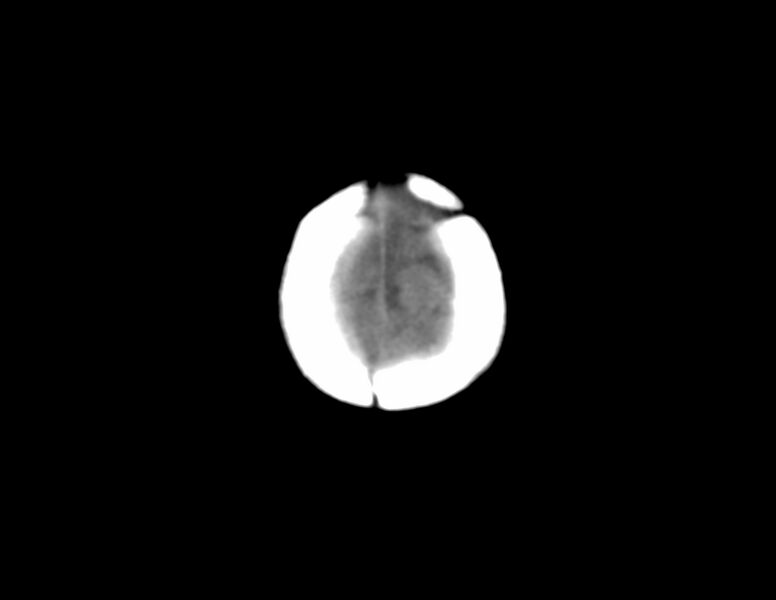 File:Anterior plagiocephaly (Radiopaedia 71836-82273 Axial non-contrast 20).jpg