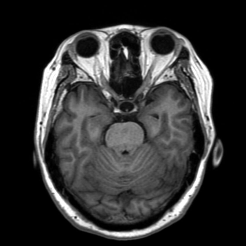Anti-MOG encephalomyelitis (Radiopaedia 73831-84646 Axial T1 18).jpg