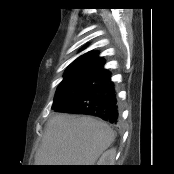 File:Aortic arch graft infection (FDG PET-CT) (Radiopaedia 71975-82437 C 11).jpg