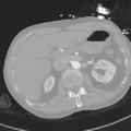 Aortic dissection - DeBakey type II (Radiopaedia 64302-73082 Axial lung window 67).png