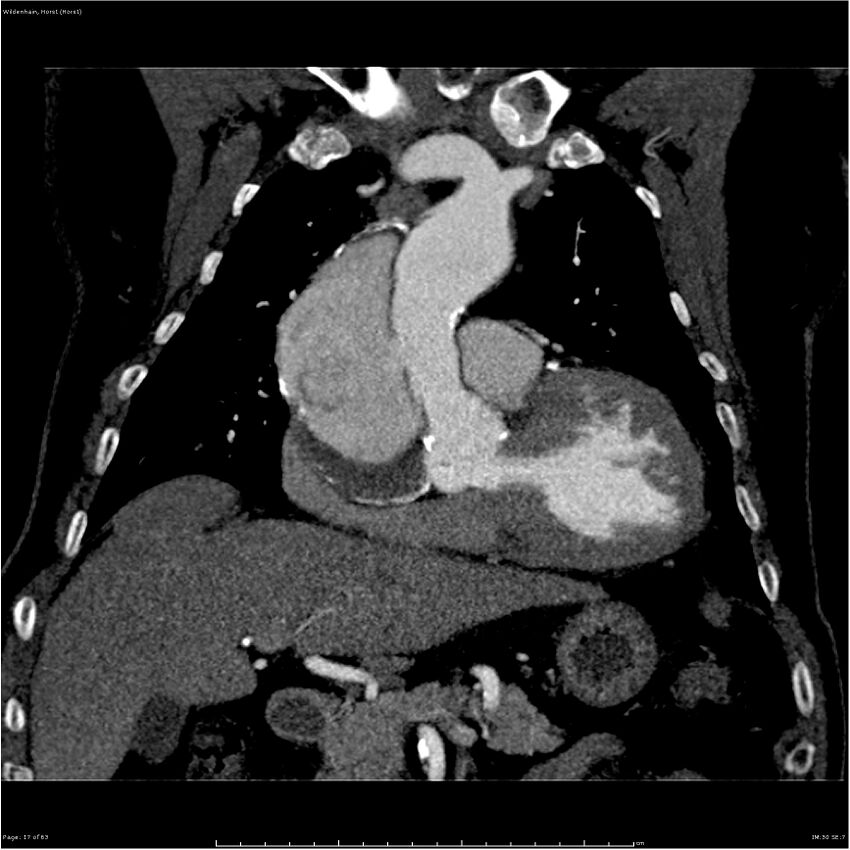 Aortic dissection - Stanford type A (Radiopaedia 26183-26315 A 17).jpg