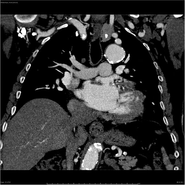 File:Aortic dissection - Stanford type A (Radiopaedia 26183-26315 A 31).jpg