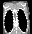 Aortic valve non-coronary cusp thrombus (Radiopaedia 55661-62189 C 68).png