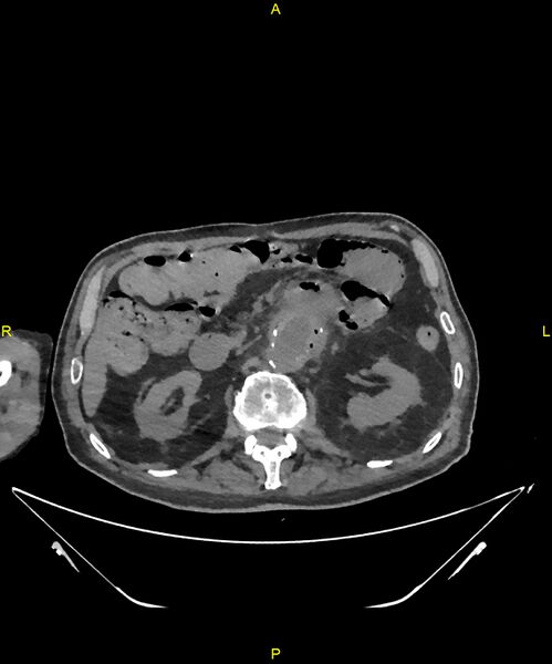 File:Aortoenteric fistula (Radiopaedia 84308-99603 Axial non-contrast 128).jpg