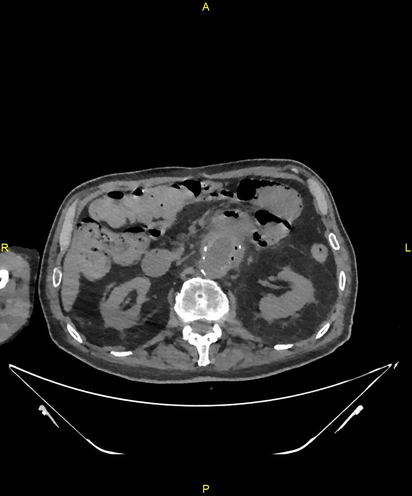 Aortoenteric fistula (Radiopaedia 84308-99603 Axial non-contrast 128).jpg