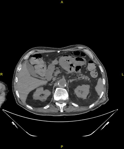 File:Aortoenteric fistula (Radiopaedia 84308-99603 Axial non-contrast 91).jpg