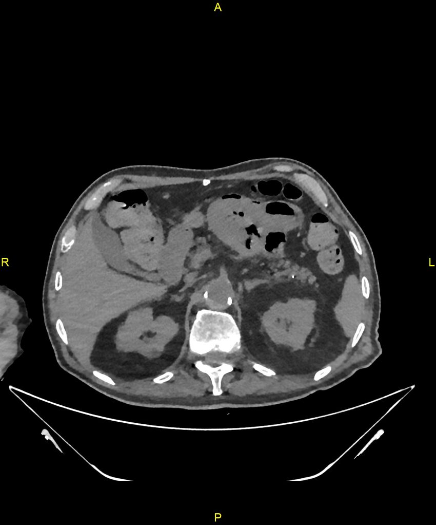 Aortoenteric fistula (Radiopaedia 84308-99603 Axial non-contrast 91).jpg