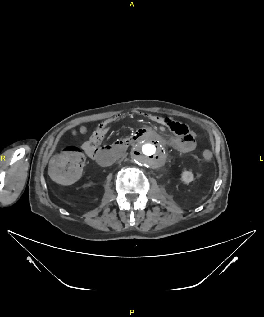 Aortoenteric fistula (Radiopaedia 84308-99603 B 172).jpg